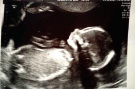 Grossesse : la prééclampsie augmente le risque de malformation cardiaque