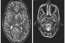 Ces tâches blanches dans le cerveau d'un homme étaient en fait des dizaines de larves
