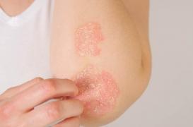 Journée nationale de l'eczéma : le vrai du faux sur une maladie de peau courante 