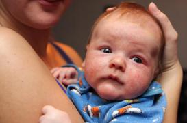 Eczéma du nourrisson : les antibiotiques inutiles en cas d'infection 