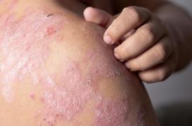 Pourquoi l'eczéma peut être associé à un risque plus élevé de décès