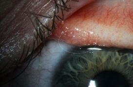 Aux Etats-Unis, les médecins extirpent 14 vers de l'oeil d'une patiente