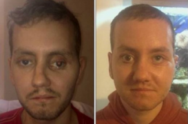 Première reconstruction du visage avec une imprimante 3D