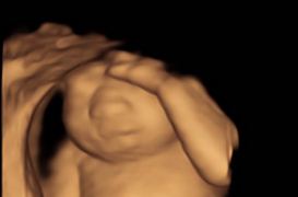 Keri Young : le bébé est condamné mais pas ses organes