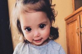 Cette belle petite fille doit ses grands yeux noirs à une maladie génétique rare