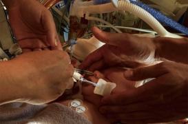 Lésions cérébrales chez les bébés : la surprenante piste du lait maternel intranasal