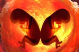 Une femme de 45 ans retrouve son jumeau dans son ovaire 