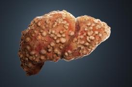 Stéatose hépatique : un foie d’alcoolique… sans boire une seule goutte