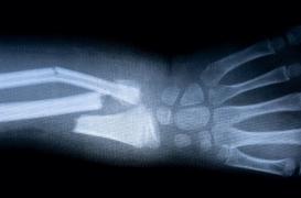 Un médicament pour accélérer la consolidation des os est prêt pour les essais cliniques