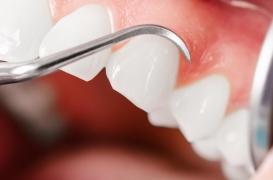 Les Omega-3 permettent de régénérer la gencive