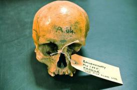 Génétique : l’hémochromatose ne vient pas d’Irlande