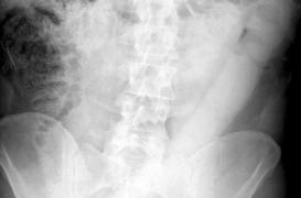 Des médecins inventent un nouvel outil pour retirer un énorme godemichet du rectum d'un homme