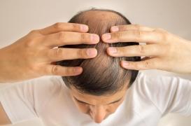 Un patch à micro-aiguilles pour venir à bout de la calvitie 