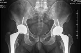 Prothèse de hanche : un patient met en cause l'Agence du médicament
