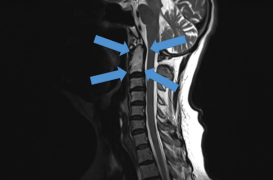 Un Australien sauvé grâce à des vertèbres imprimées en 3D 
