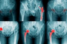 Ostéoporose: les facteurs de risque de fracture mieux identifiés
