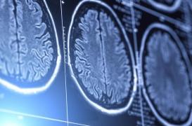 Cancer du cerveau : les femmes et les hommes ne devraient pas être traités pareil