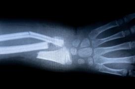 Aux urgences, une intelligence artificielle française améliore considérablement la prise en charge des fractures