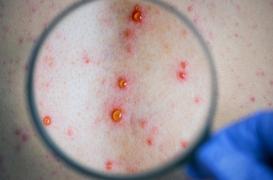 Les cas de syphilis en Europe sont en hausse de 70% depuis 2010