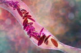 La drépanocytose, première maladie génétique en France