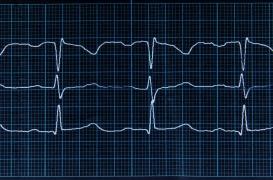 Fibrillation atriale : la structure des canaux sodiques décryptée 