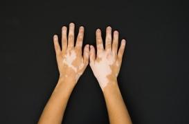 Vitiligo : une maladie bénigne toujours stigmatisée en France