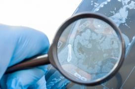 MICI, maladie de Crohn : deux options thérapeutiques prometteuses