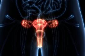 Cancer de l'ovaire : souvent silencieux, parfois héréditaire