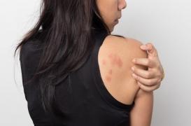 Coronavirus : les dermatologues alertent sur de possibles symptômes cutanés