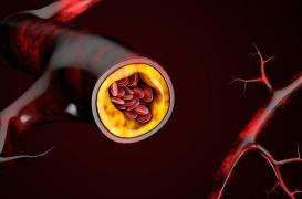 Athérosclérose : la maladie se développe très vite entre 40 et 50 ans 
