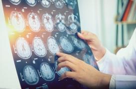 Maladie d'Alzheimer : pourquoi l'immunothérapie intéresse tant les chercheurs ? 