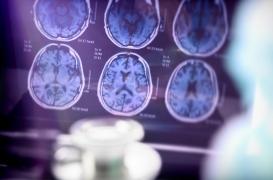 Maladie d'Alzheimer : où en sommes-nous dans les traitements ? 