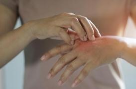 Des variations génétiques provoquent l’eczéma