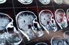 Coronavirus : une patiente développe une maladie cérébrale rare