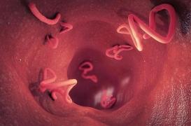 Souffrant de migraines, il découvre qu'un ver parasite pond des œufs dans son cerveau