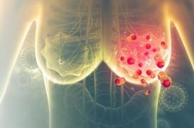 Cancer du sein métastatique : les soins de support sont essentiels