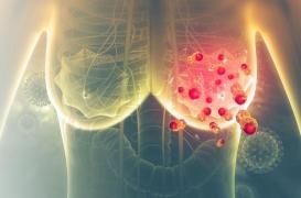 Cancer du sein : le gène responsable des formes très agressives identifié