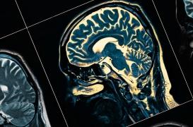 Parkinson : les signes de la maladie seraient visibles dès la naissance