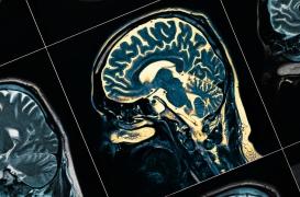 ​​Parkinson : un dispositif qui envoie de la dopamine directement dans le cerveau 