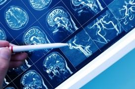 Démence vasculaire : cette protéine augmente les risques d'en souffrir