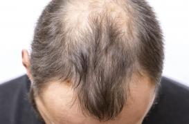 Comment le stress empêche les cheveux de pousser