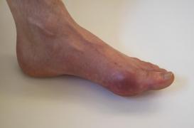 Crises de goutte : les boissons sucrées sont à éviter 