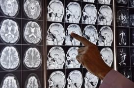 Covid long : la perte d'odorat est liée à des changements dans le cerveau