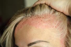 Psoriasis : le tabagisme réduit l'efficacité des traitements 