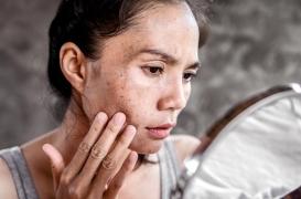 Pourquoi trop s’exposer au soleil « durcit » la peau