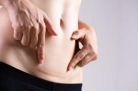 Césarienne : ses effets sur le microbiote diffèrent en fonction du sexe 