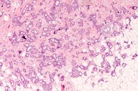 Cancer du sein : un catalogue des cellules mammaires pour prévenir le risque 