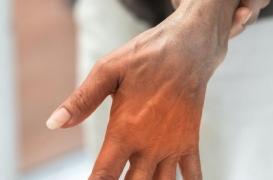 La force de préhension, facteur d’identification du diabète de type 2