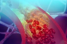 Athérosclérose : un traitement plus puissant pourrait être nécessaire chez les femmes 