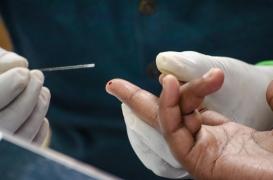 Ostéoporose : prédire le risque avec une simple goutte de sang